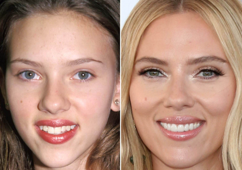 Celebrity before and after dentures