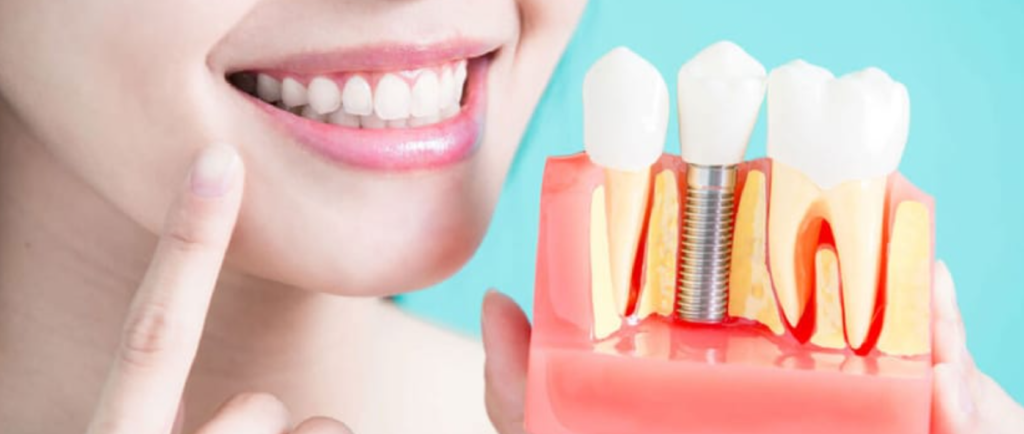 Dental Implants Cost