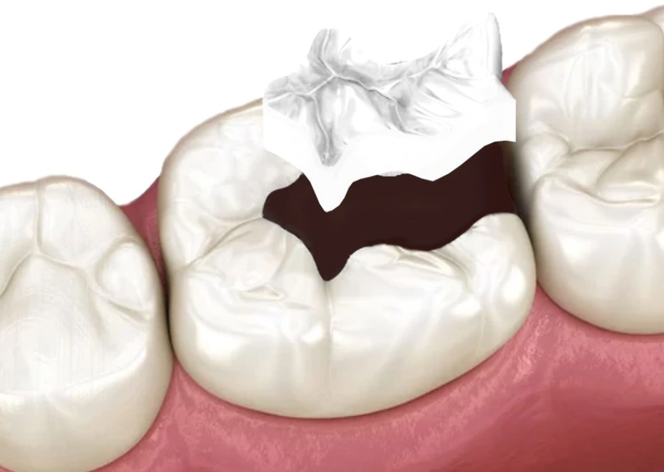 How much do dental fillings cost?