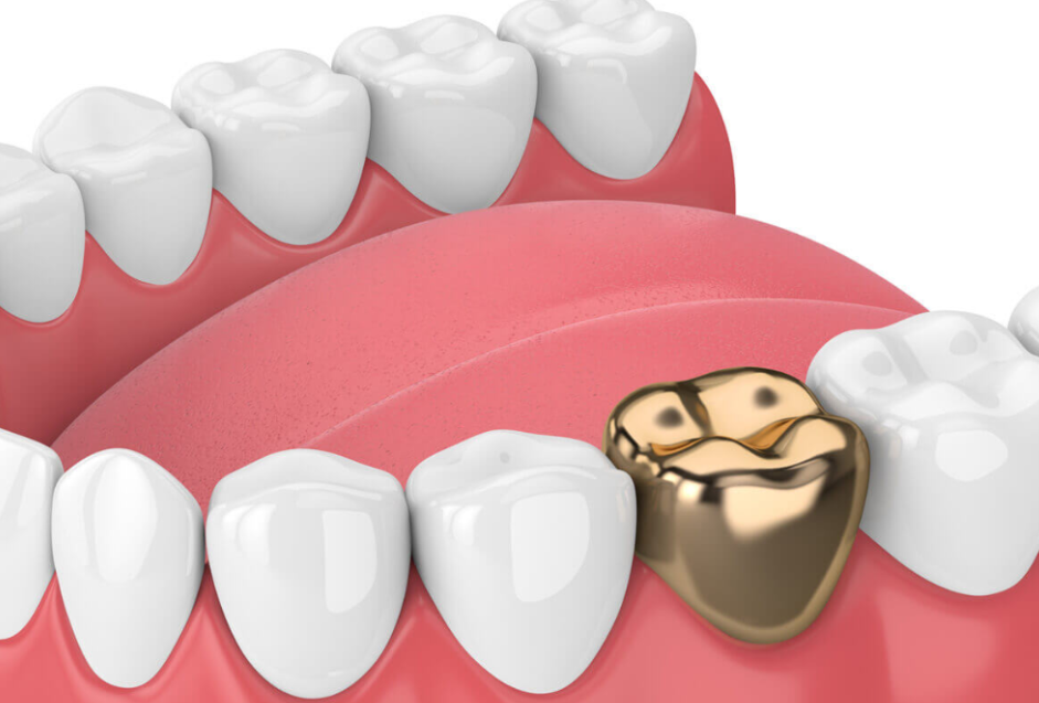Gold denture teeth