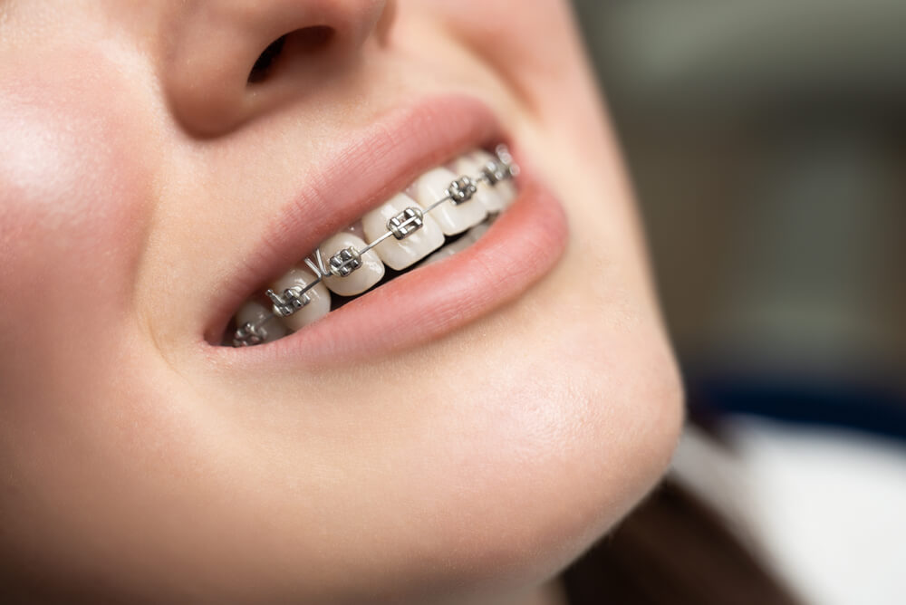 Dental Braces on Yonge & Eglinton - Dr.Niosha Orthodontic