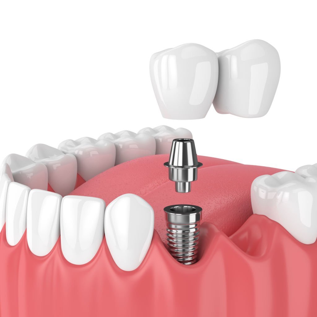dental implant in yonge