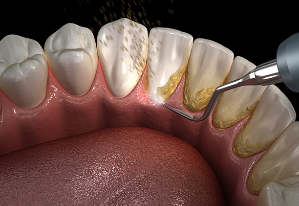 periodontal-maintenance-1